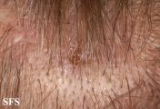 myiasis-furuncular myiais