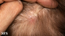 myiasis-furuncular myiais