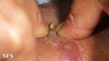 myiasis-furuncular myiais