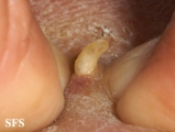 myiasis-furuncular myiais