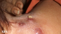 myiasis-furuncular myiais