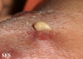 myiasis-furuncular myiais