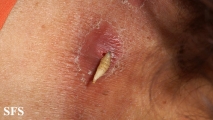 myiasis-furuncular myiais