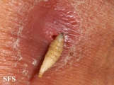 myiasis-furuncular myiais