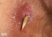 myiasis-furuncular myiais