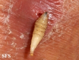 myiasis-furuncular myiais