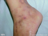 livedoid vasculopathy