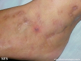 livedoid vasculopathy