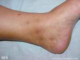 livedoid vasculopathy