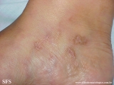 livedoid vasculopathy