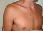 erythema multiforme
