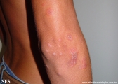 erythema multiforme