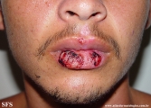 erythema multiforme