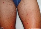 erythema multiforme