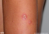 erythema multiforme