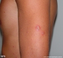 erythema multiforme