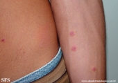 erythema multiforme