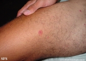 erythema multiforme