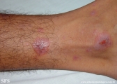 erythema multiforme