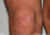 erythema multiforme