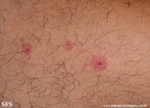 erythema multiforme