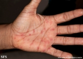 erythema multiforme