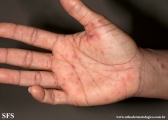 erythema multiforme