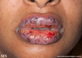erythema multiforme