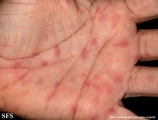 erythema multiforme
