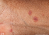 erythema multiforme