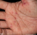 erythema multiforme