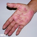 erythema multiforme