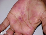 erythema multiforme