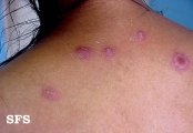erythema multiforme