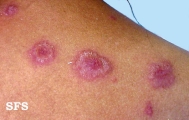 erythema multiforme