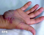 erythema multiforme