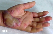 erythema multiforme