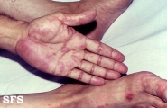 erythema multiforme