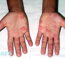 erythema multiforme