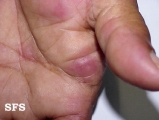 erythema multiforme