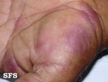 erythema multiforme