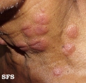 erythema multiforme