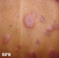 erythema multiforme