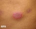 erythema multiforme