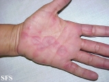 erythema multiforme