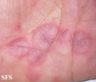 erythema multiforme