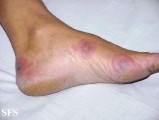 erythema multiforme