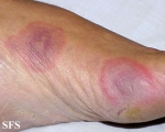 erythema multiforme