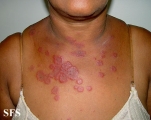 erythema multiforme