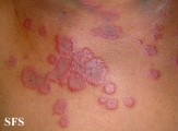 erythema multiforme
